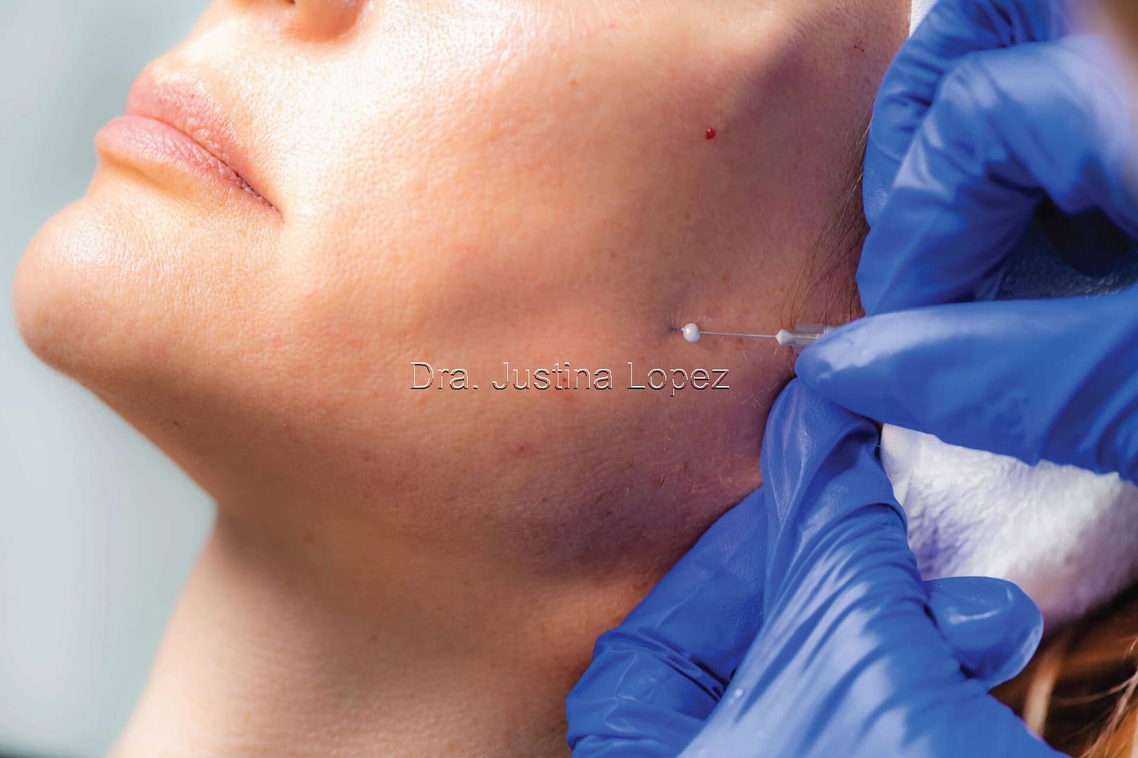 Bioremodelación 5 y 8 puntos