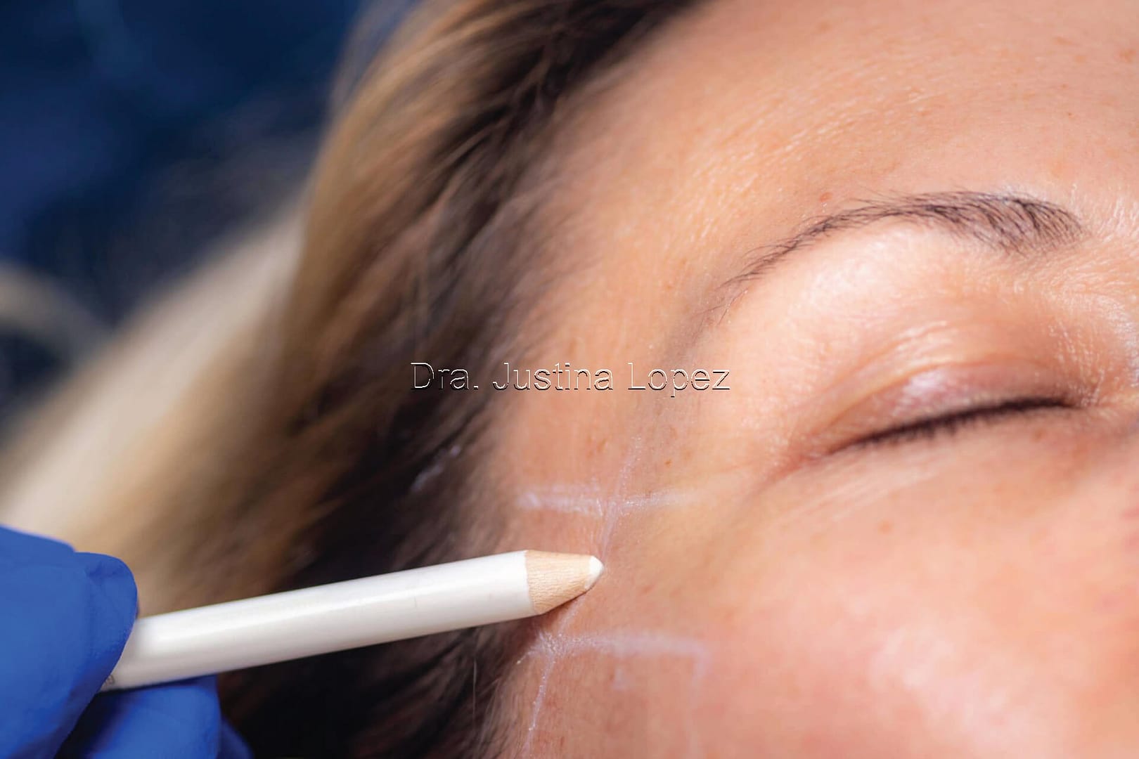 Fadenlifting (PLLA und PDO)