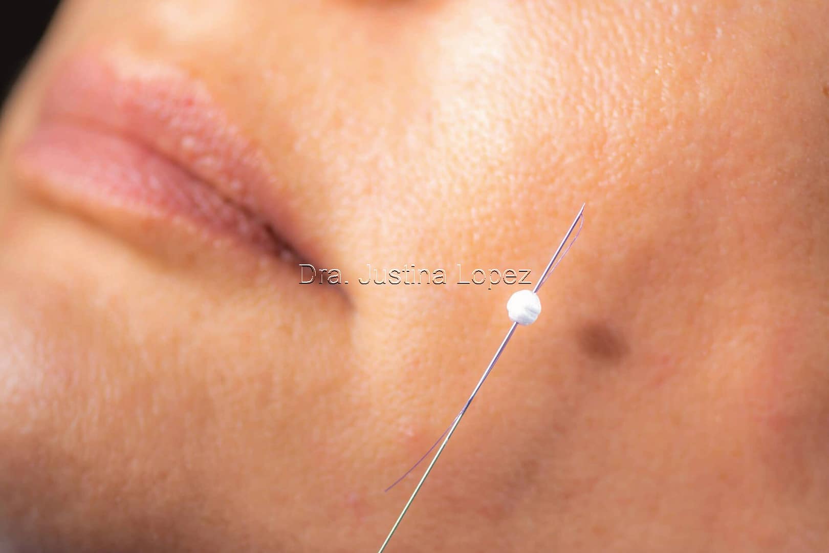 Lifting facial con hilos Tensores